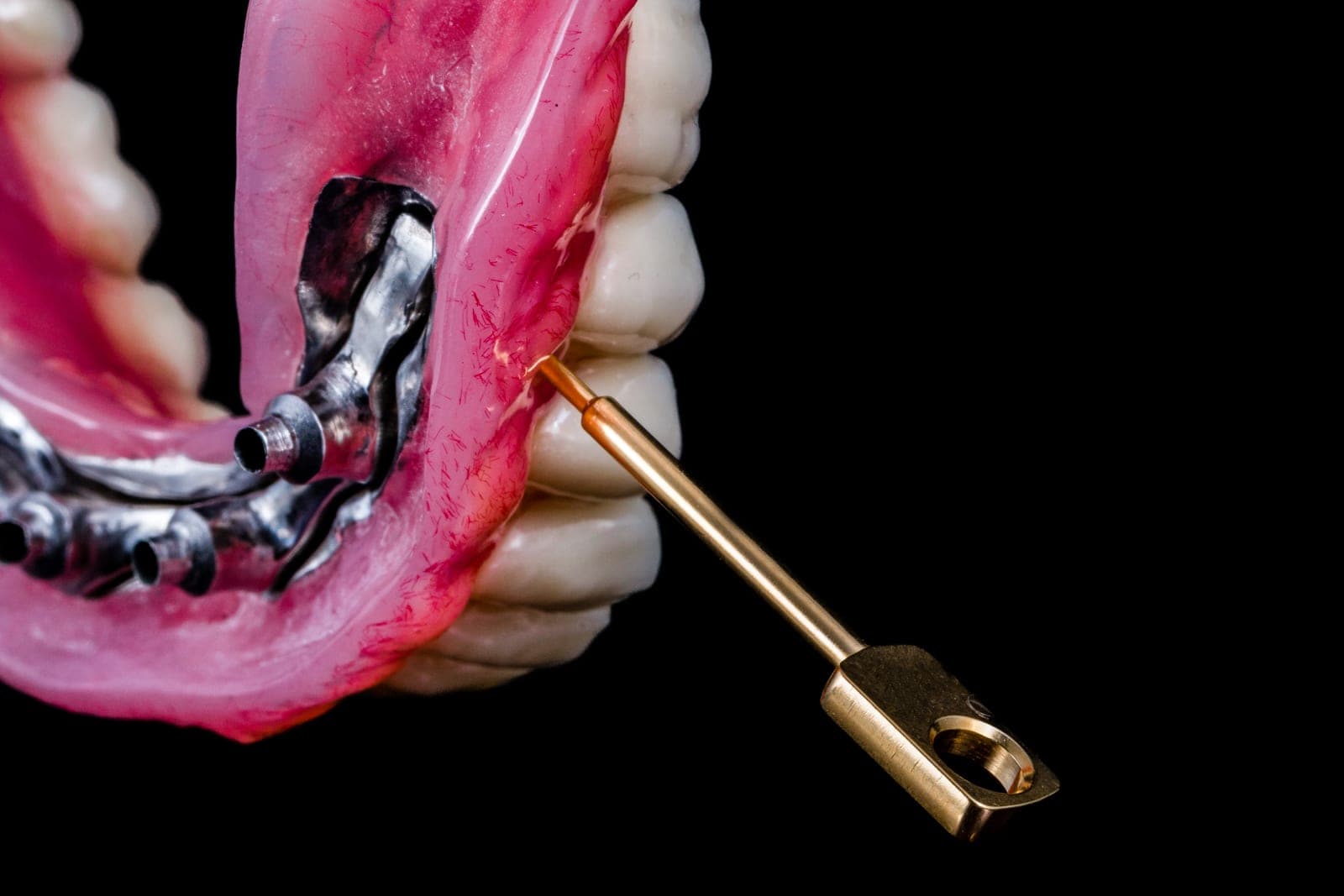 Implant-retained overdenture with Locator attachments