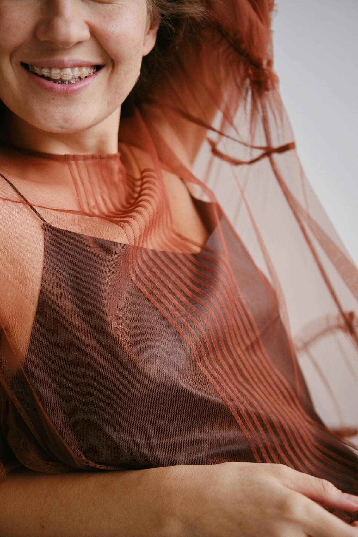 Teen braces result — severe crowding corrected in 20 months